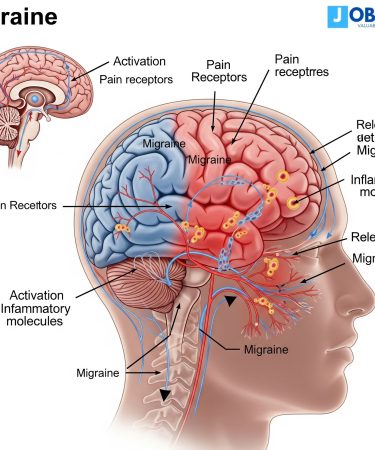 Migraine : فهم مرض والعلاجات المرتبطة بالصداع النصفي